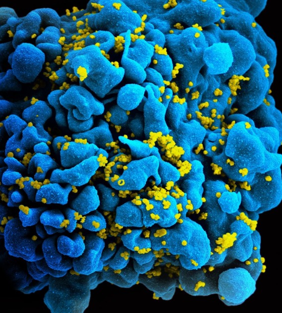 HIV particles infecting a T-cell, viewed under a scanning electron microscope. T-cells perform important functions in our immune system.